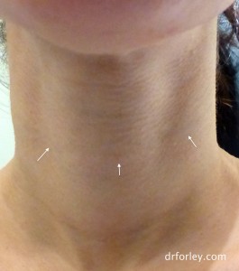 After TREATMENT FOR NECK WRINKLES