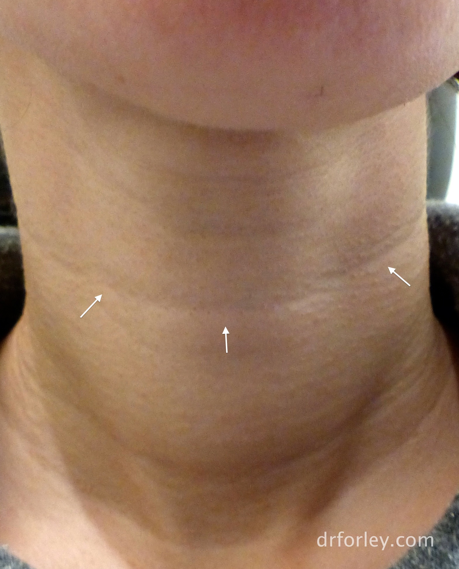 Blog - A NEW TREATMENT FOR NECK WRINKLES Photo 