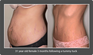 Before & After 31 year old female 3 months following a tummy tuck