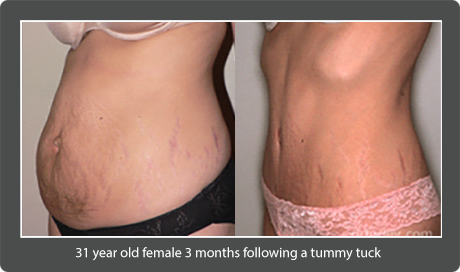 Female body, Before and After TUMMY TUCK treatment, oblique view