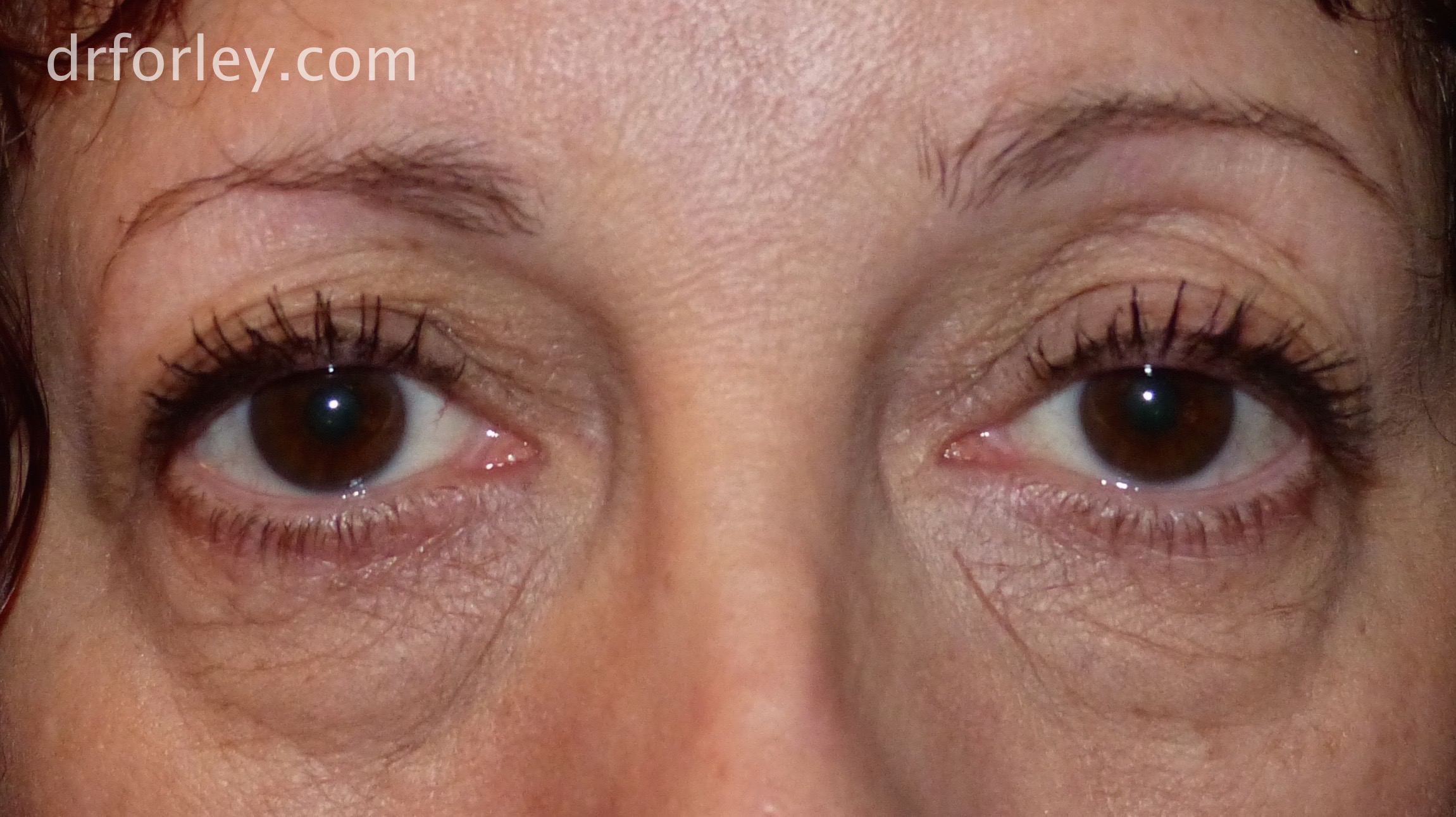 Blog - TEAR TROUGHS AND BAGGY LOWER EYELIDS Photo 