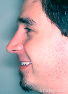 Male patient face, after Rhinoplasty treatment, side view