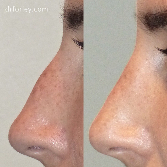 Blog - RHINOPLASTY: WHEN LESS CAN BE MORE Photo Woman's face, before and after Rhinoplasty treatment, side view, patient 2