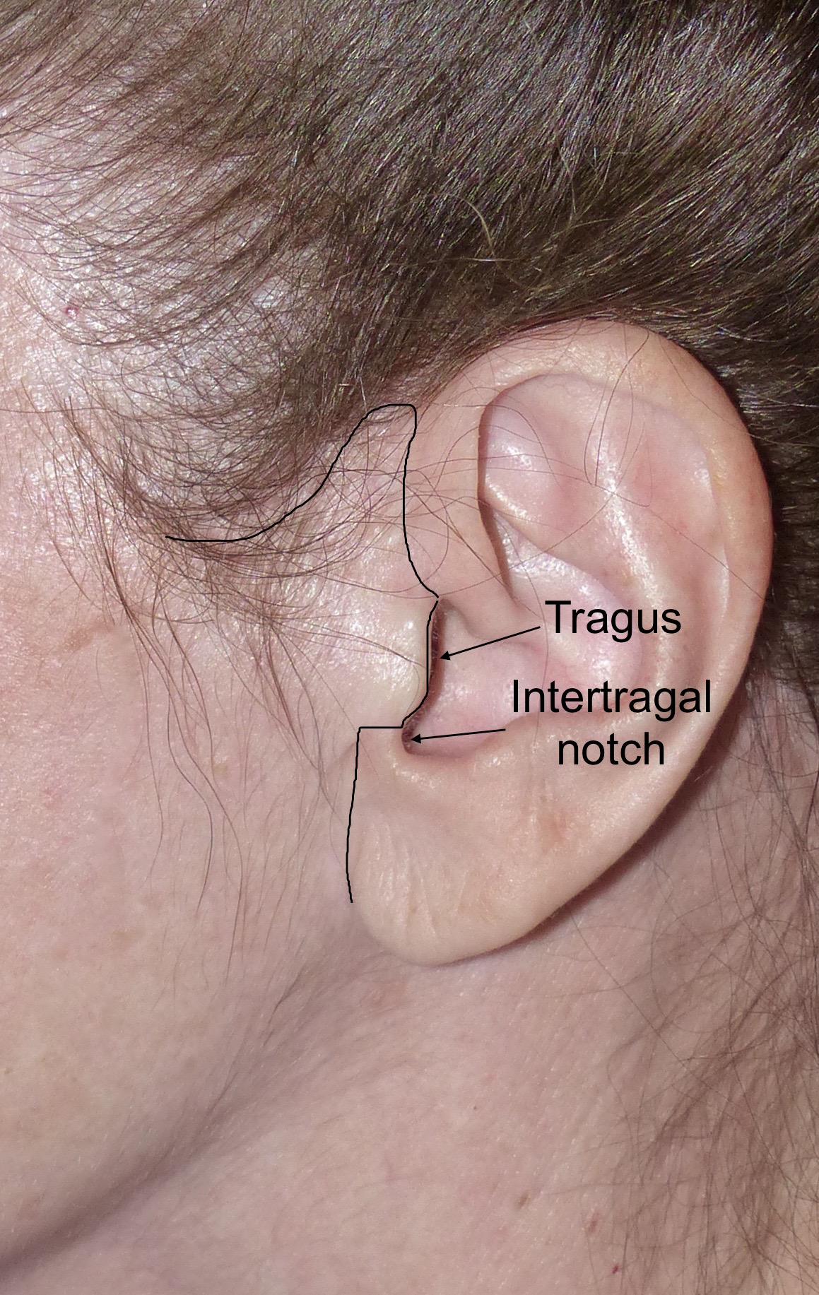 Female ear zone - Tragus, Intertragal notch