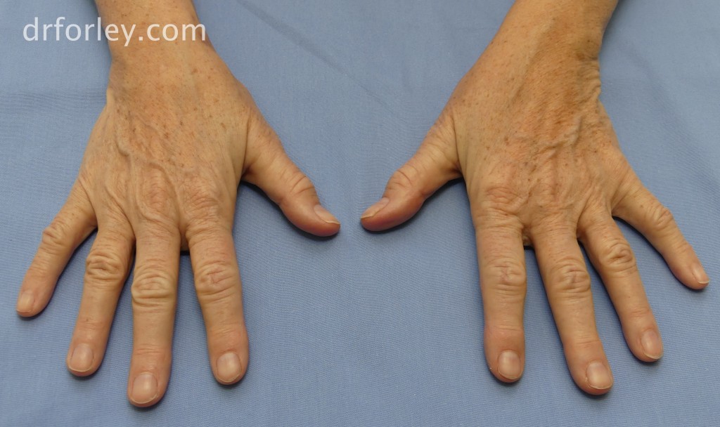 63 year old female with age spots of the hands