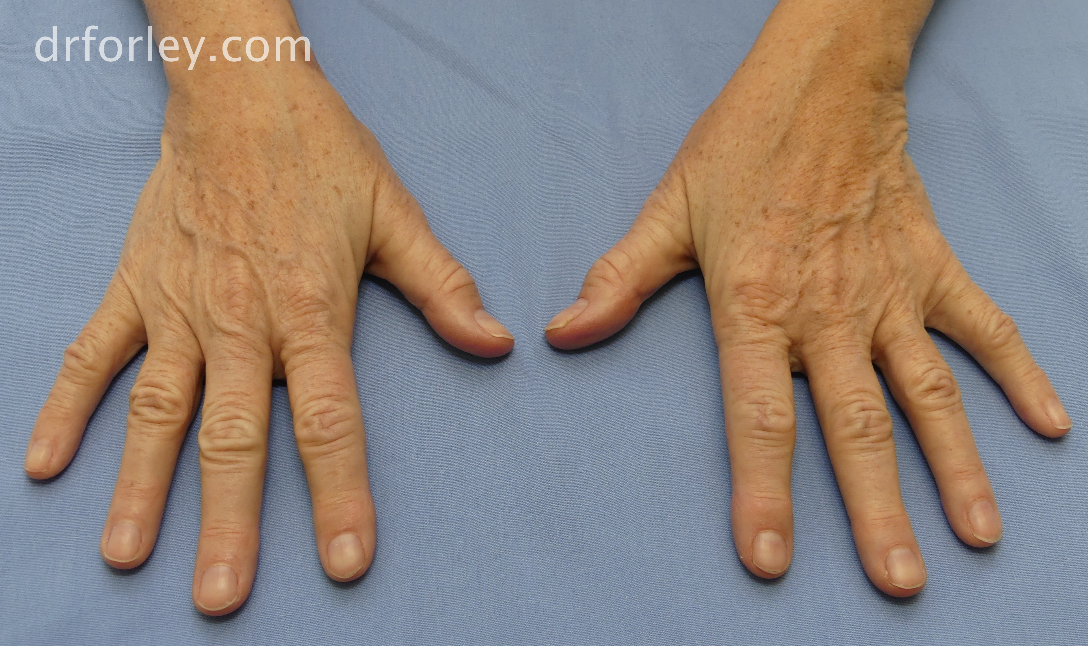 Blog - TREATING AGE SPOTS ON THE HANDS Photo Woman's hands, 64 year old female 1 month following a single Nordlys broad band light treatment of age spots