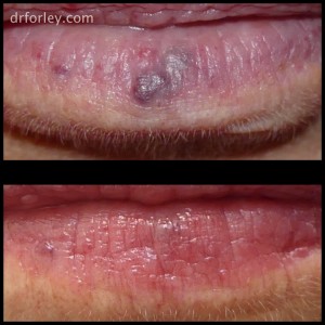74 year old female following 2 treatments of lower lip venous lake with Nordlys Nd:YAG laser
