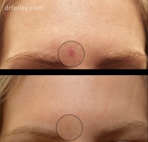 39 year old female 3 weeks after 2 Nordlys Nd:YAG laser treatments of the red spider angioma of her forehead