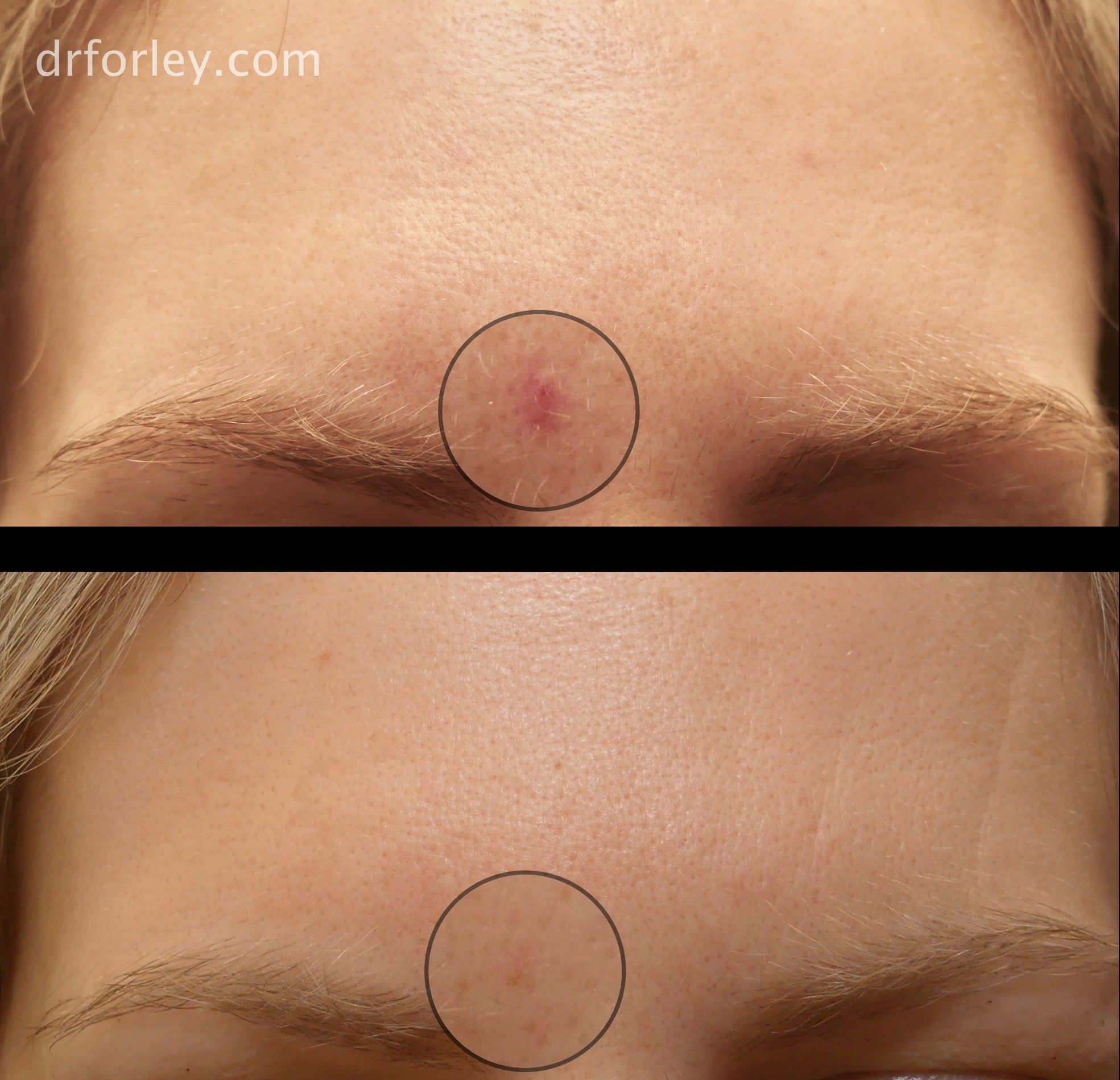 Blog - Nd:YAG LASER TREATMENT OF VASCULAR SKIN CONDITIONS Photo 