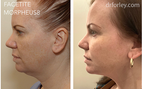 Female face, before and after Facetite and Morpheus8 treatment, side view, patient 2