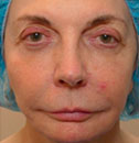 Blog - FACETITE PATIENT TESTIMONIALS Part 2 Photo 