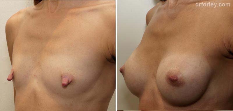 Woman's breasts, Before and After Treatment photo, oblique view, female patient 1