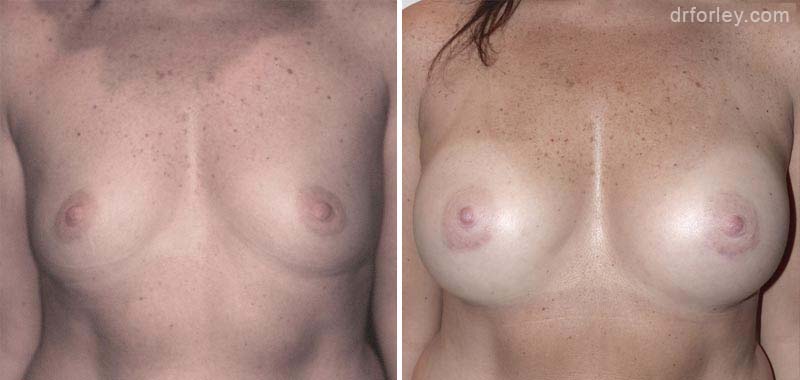 Woman's breasts, Before and After Treatment photo, front view, female patient 2