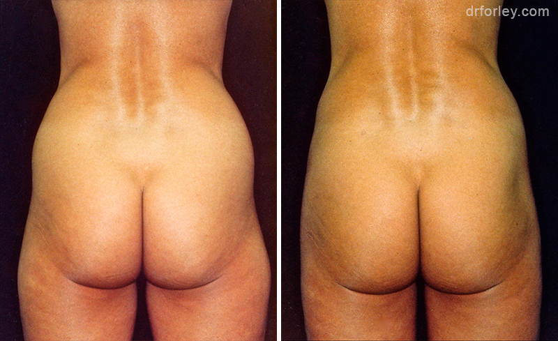 Patient buttok, before and after liposuction treatment, back view, patient 1