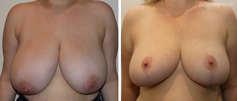 Female breast, before and after Breast Lift treatment, front view, patient 1