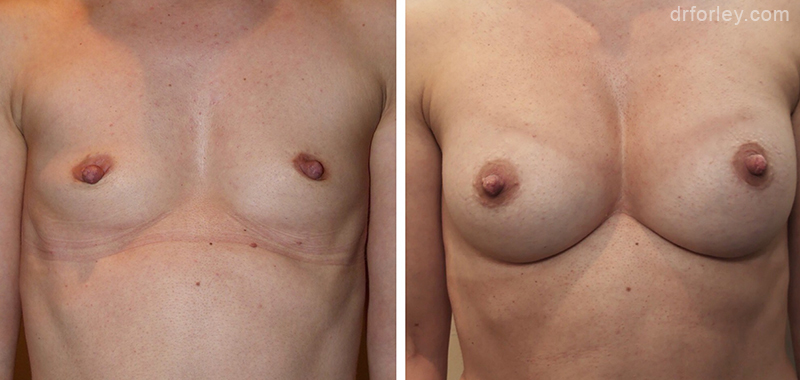 Woman's breasts, Before and After Treatment photo, front view, female patient 3