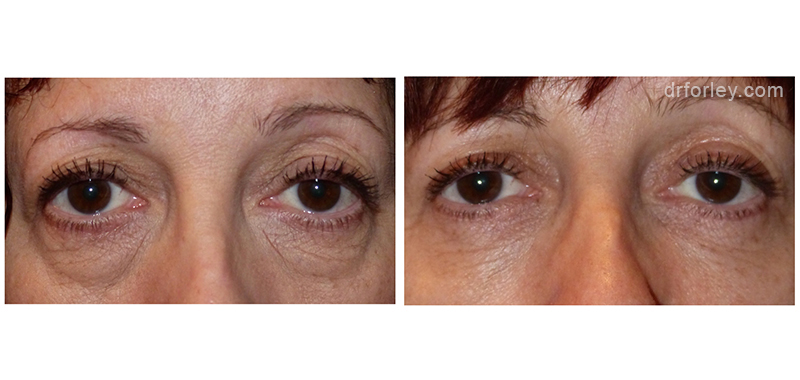 Female face, before and after Eyelid Surgery treatment, front view, patient 3