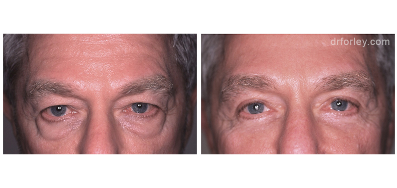 Male face, before and after Eyelid Surgery treatment, front view, patient 4