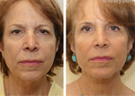 Woman's face Before and After Facelift treatment, front view, patient 3