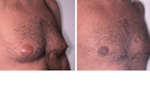 Male breasts, before and after Gynecomastia, oblique view, patient 1