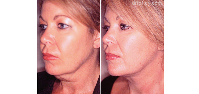 Woman's Face, before and after necklift treatment, neck, left side oblique view, female patient 1