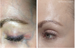 Woman’s face, before and after Nd:YAG laser treatment, oblique view, patient 1