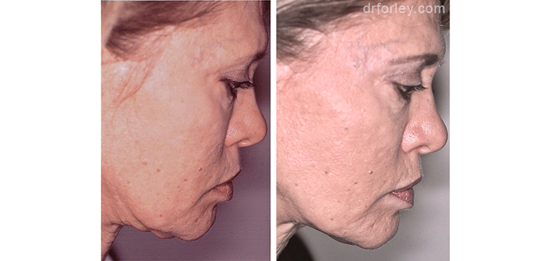 Female face, before and after Ultherapy treatment, side view, patient 10