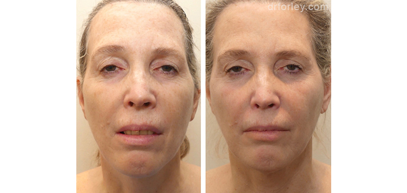 Female face, before and after Facetite treatment, front view, patient 3