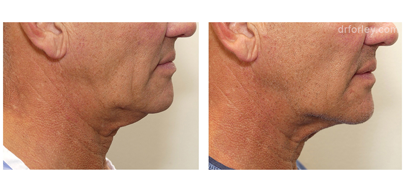 Male face, before and after FaceTite treatment, side view, patient 12