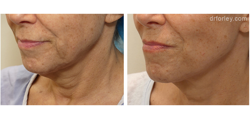 Female face, before and after Facetite treatment, oblique view, patient 4