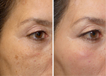 Woman’s face, before and after Nordlys treatment, oblique view, patient 2