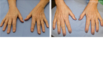 Woman’s hands, before and after Nordlys treatment, front view, patient 3