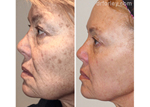 Woman’s face, before and after Nordlys treatment, side view, patient 4