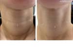 Female neck, before and after Injectable Fillers treatment, front view, patient 2