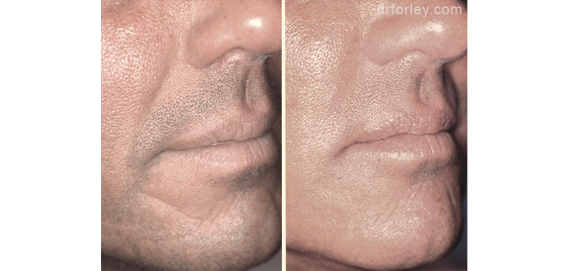 Male face, before and after Restylane treatment, front view, patient 11