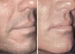 Male face, before and after Injectable Fillers treatment, oblique view, patient 3