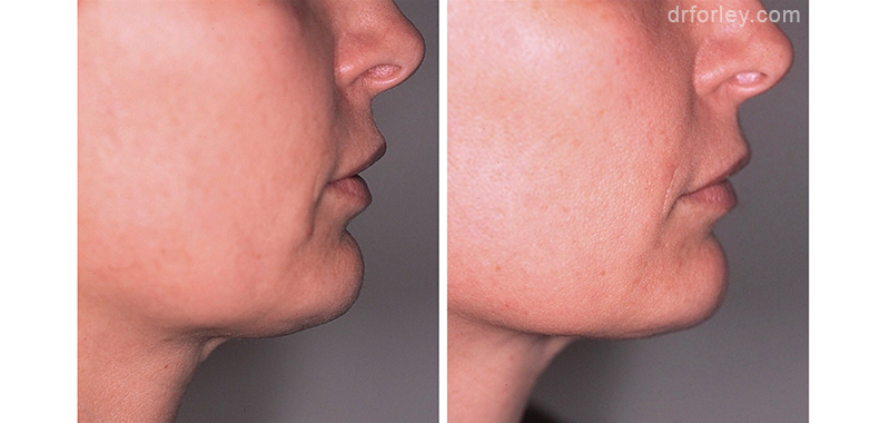 Female face, before and after Ultherapy treatment, side view, patient 9
