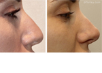 Female face, before and after rhinoplasty, nose r-side view, patient 1