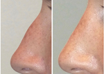 Female face, before and after rhinoplasty, nose l-side view, patient 2