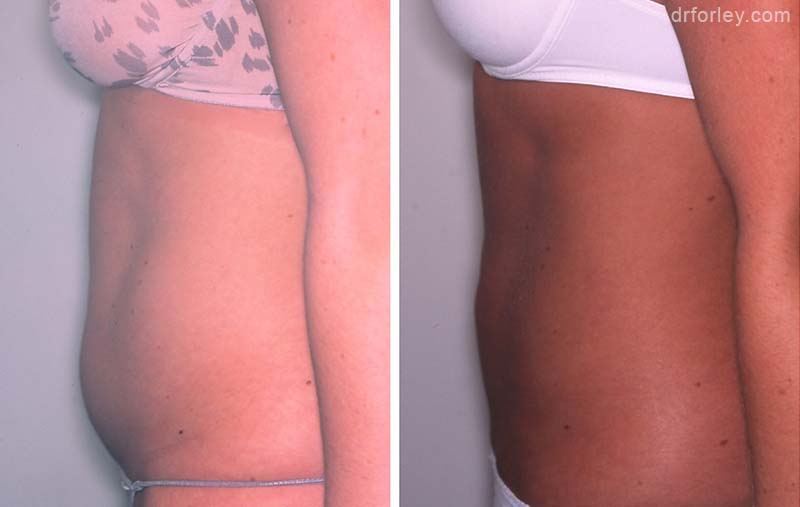 Female stomach, before and after liposuction treatment, side view, patient 4