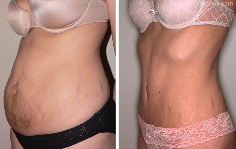 Female body, TUMMY TUCK, Before and After treatment photo, oblique view, patient 1