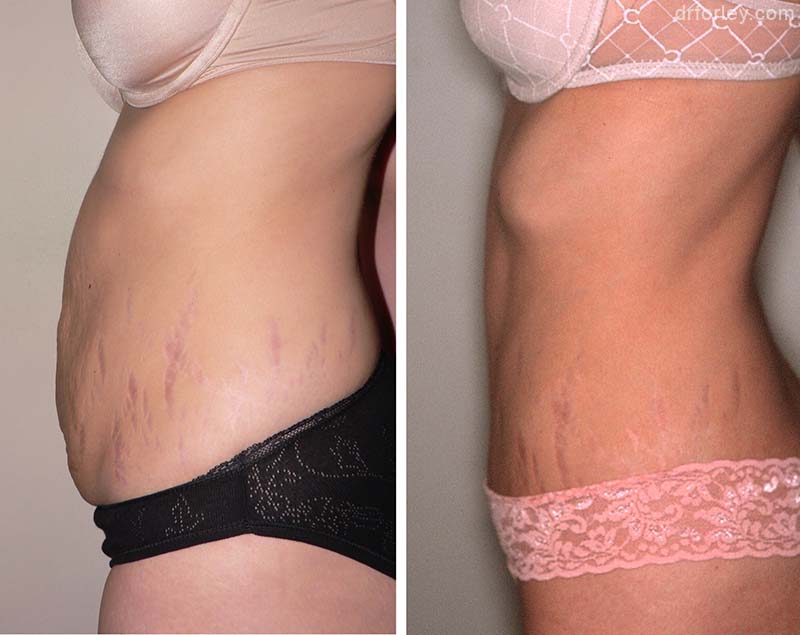 Female body, TUMMY TUCK, Before and After treatment photo, side view, patient 1