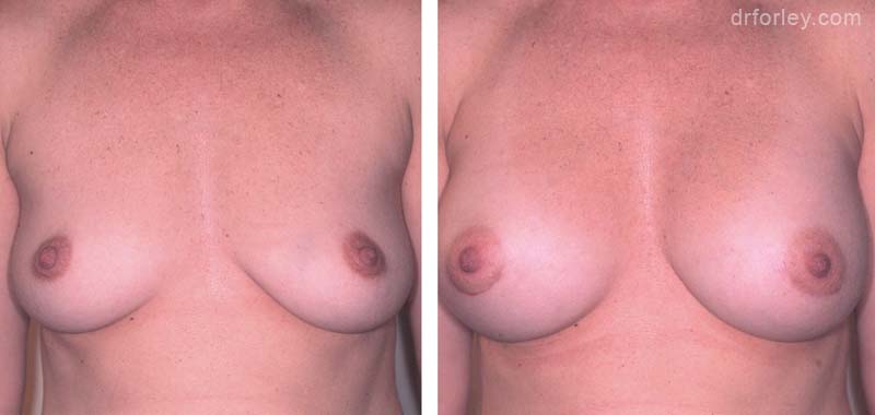 Woman's breasts, Before and After Treatment photo, front view, female patient 5