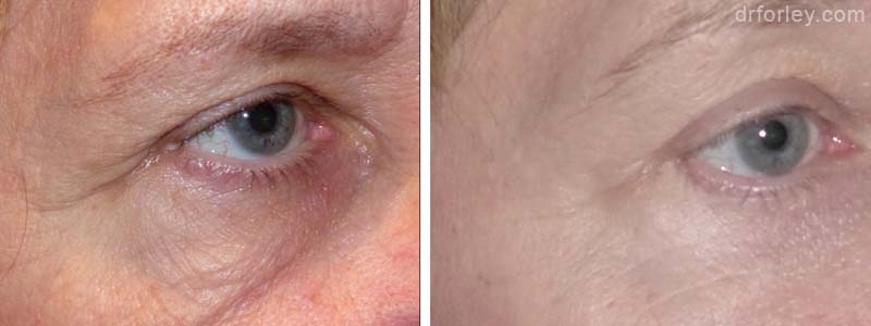 Female eye, before and after brow lift treatment, oblique view, patient 1
