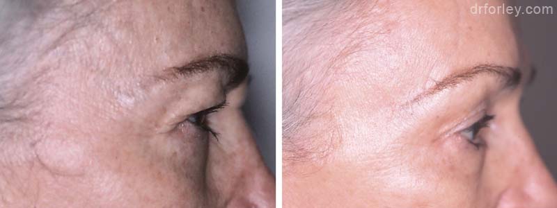 Female eye, before and after brow lift treatment, r-side view, patient 2