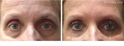 Female eye, before and after brow lift treatment, front view, patient 3