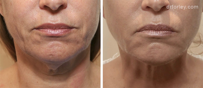 Woman’s lips, before and after FaceTite and Morpheus8 treatments, front view, patient 8