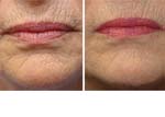 Woman’s lips, before and after Fractora treatment, front view, patient 7