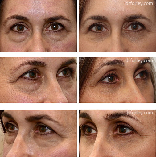 Woman's face, before and after EYELID SURGERY Treatment, female eyelid, patient 1