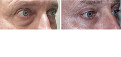 Male face, before and after Eyelid Surgery treatment, oblique view, patient 5